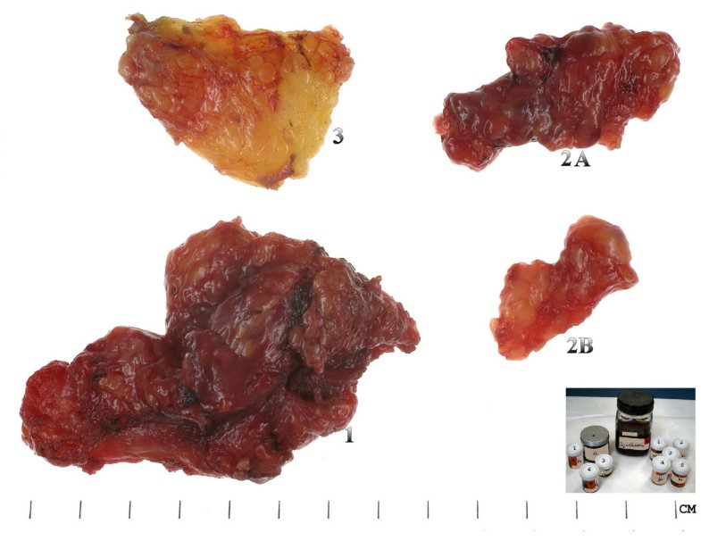 How we do it a method of neck dissection for histopathological