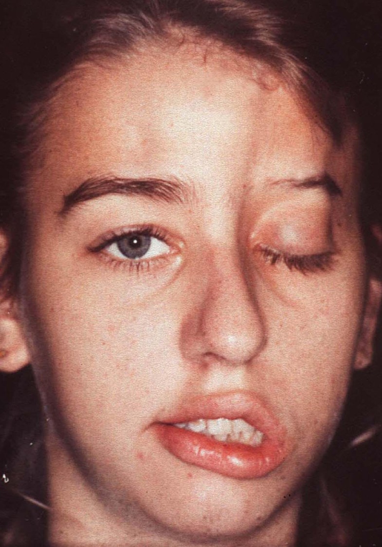 Bilateral linear scleroderma "en coup de sabre" associated with facial atrophy and neurological