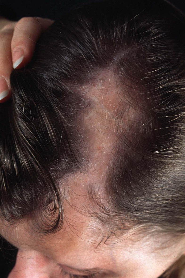 Bilateral linear scleroderma "en coup de sabre" associated with facial atrophy and neurological