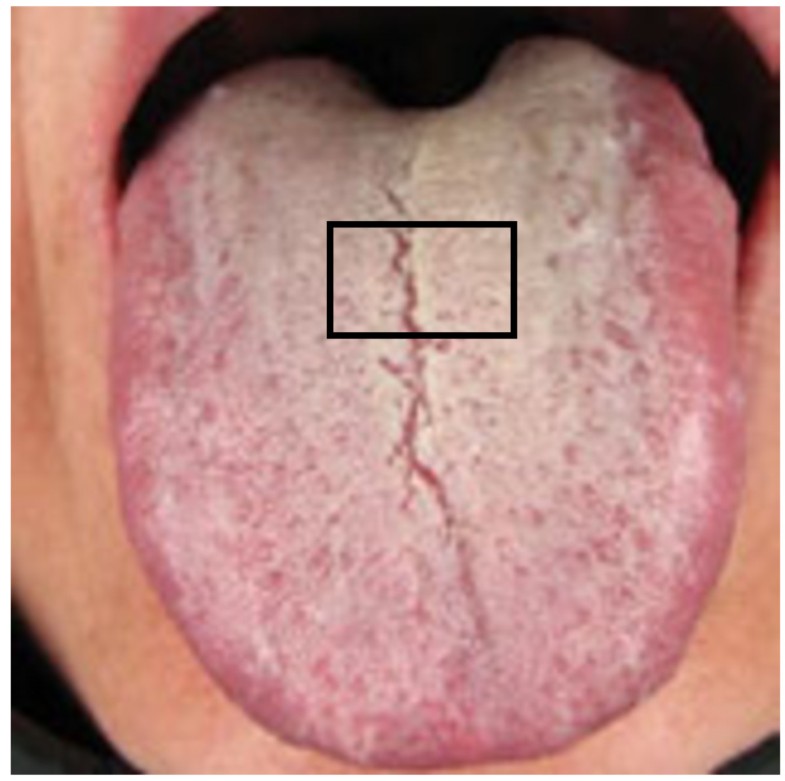 Metabolic markers and microecological characteristics of tongue coating