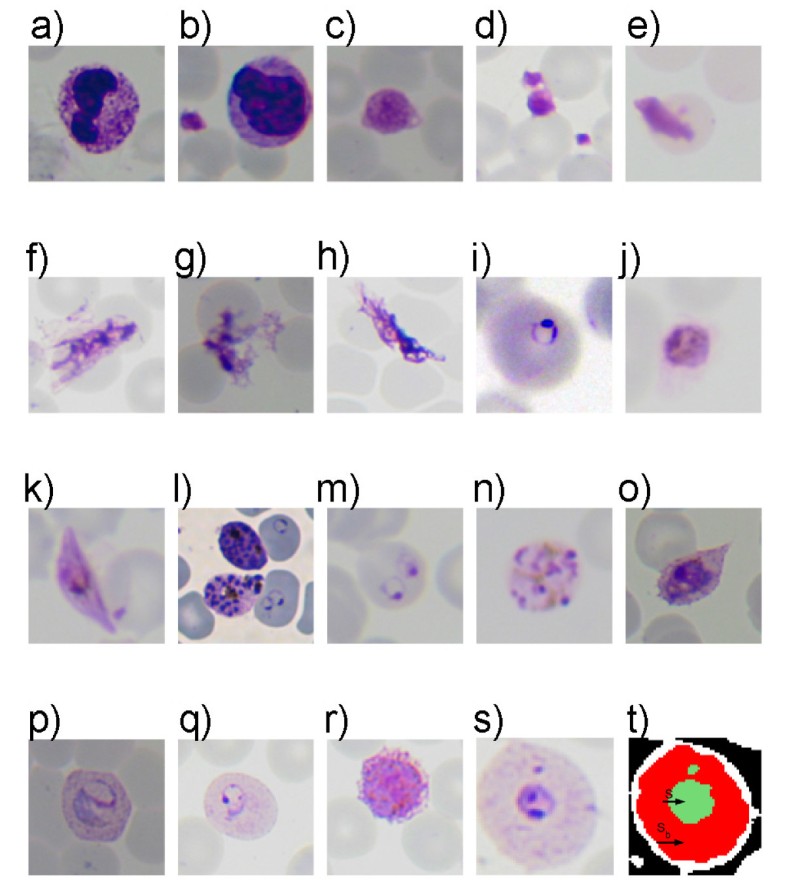 Computer vision for microscopy diagnosis of malaria Malaria Journal