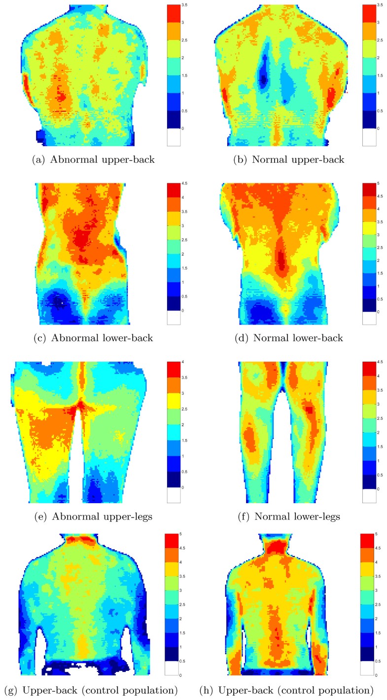 Quantitative assessment of painrelated thermal dysfunction through
