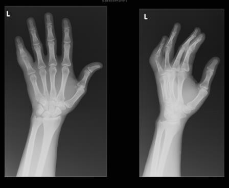 Disseminated tuberculosis presenting with finger swelling in a patient