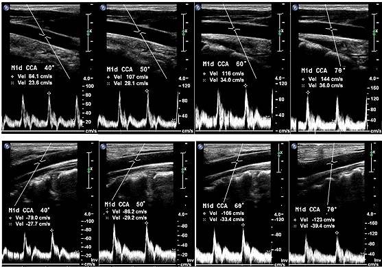 Standardized ultrasound evaluation of carotid stenosis for clinical