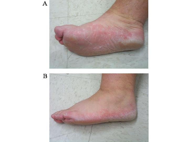 Dermatology for the practicing allergist Tinea pedis and its