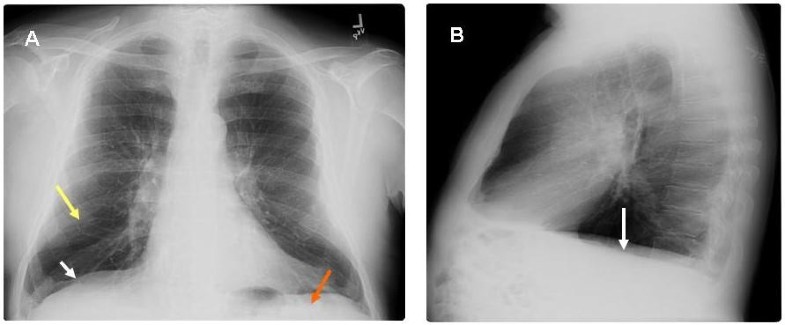 The Hoover's Sign of Pulmonary Disease: Molecular Basis and Clinical ...