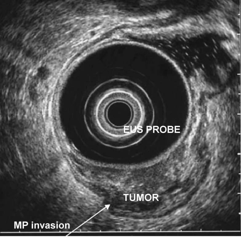The role of endoscopic ultrasound in the evaluation of rectal cancer