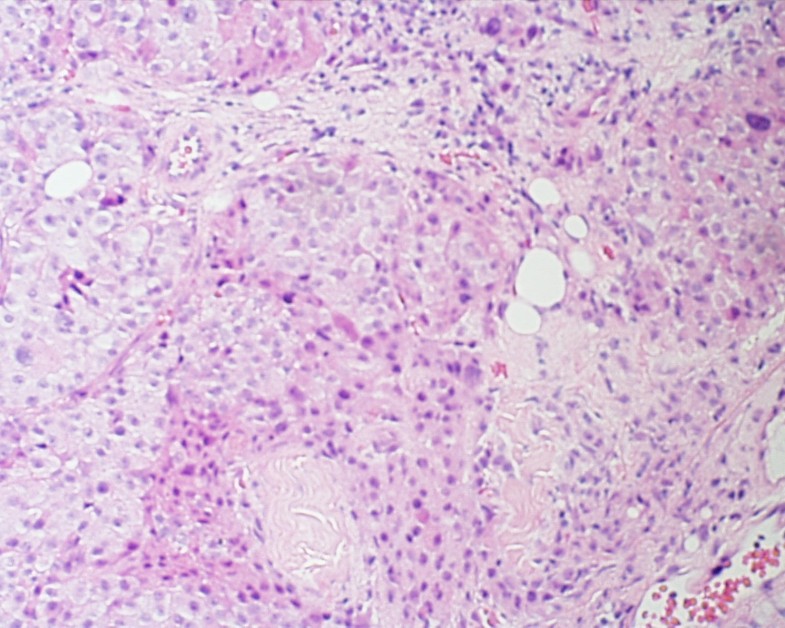 Metastatic Hurthle Cell Carcinoma of the thyroid