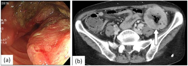 Primary lung cancer presenting with metastasis to the colon: a case