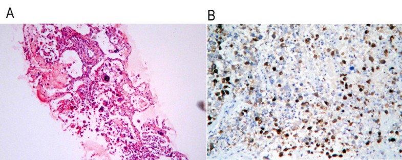 Acute small bowel obstruction: a rare initial presentation ...