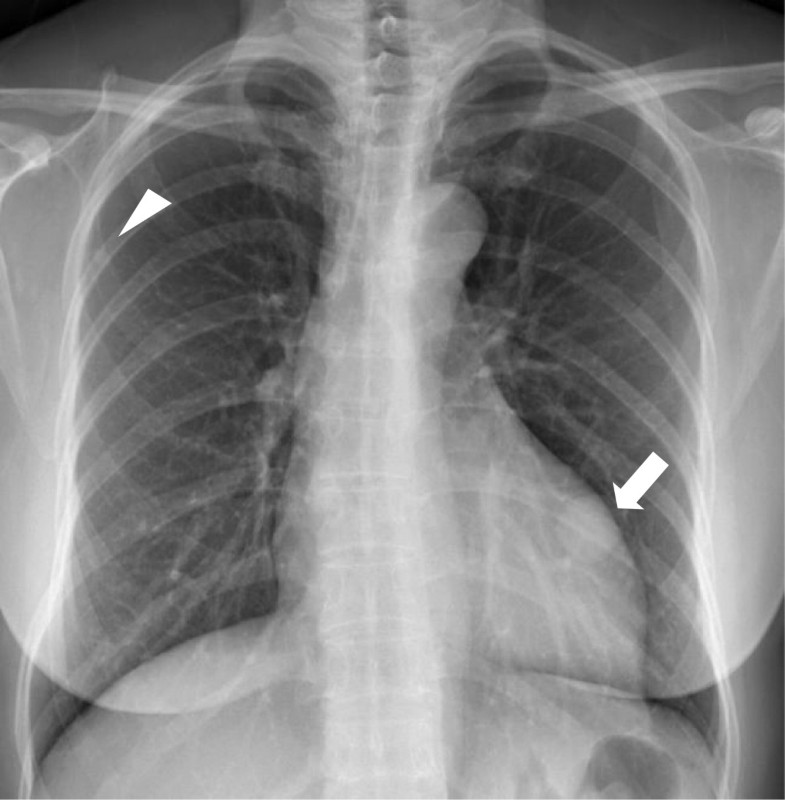 Benign metastasizing leiomyoma of the lung | World Journal of Surgical ...