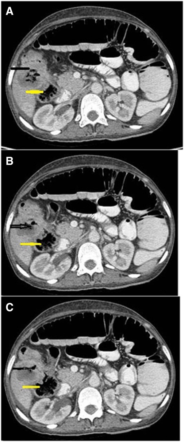 Transmural invasion of hepatic flexure of colon causing cholecystocolic