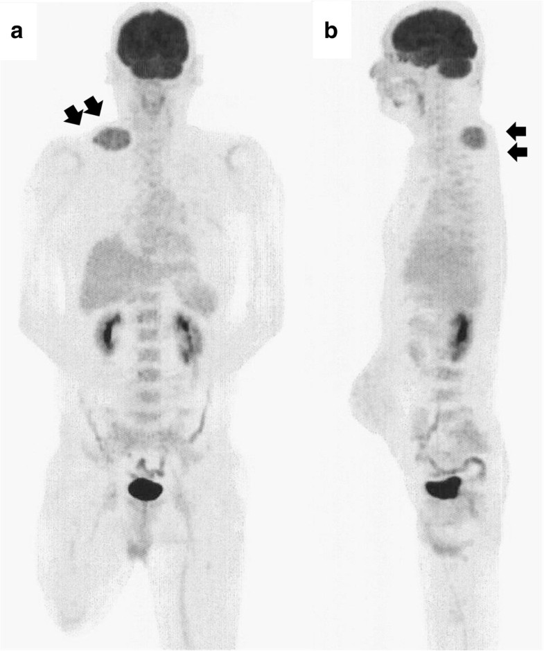 Metastasis of to the trapezius muscle a case report World Journal of Surgical
