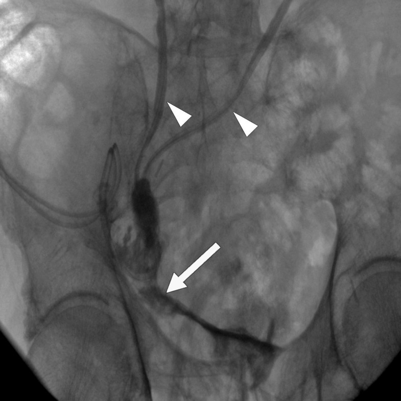 Vacuumassisted closure therapy in ureteroileal anastomotic leakage