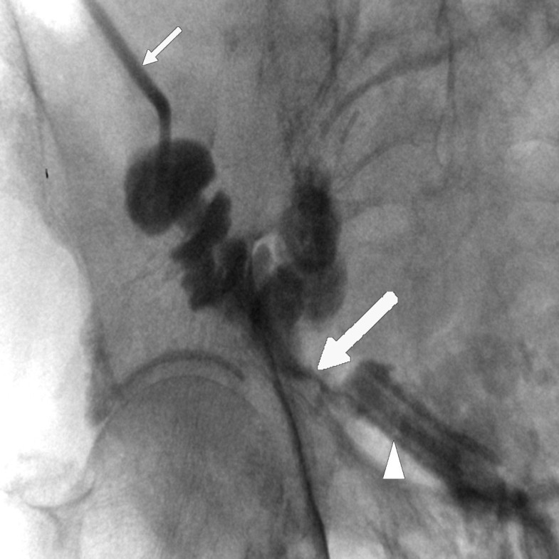 Vacuumassisted closure therapy in ureteroileal anastomotic leakage