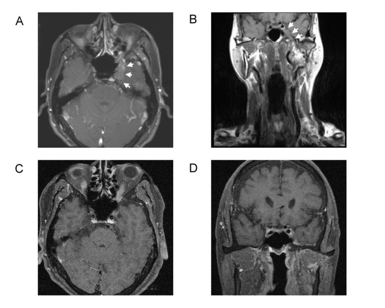 Carcinoma ex pleomorphic adenoma of soft palate with cavernous sinus