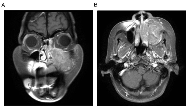 A colliding maxillary sinus cancer of adenosquamous carcinoma and small