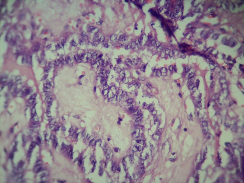 Papillary carcinoma thyroid with metastasis to ectopic cervical thymus ...