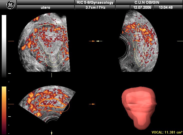 ovarian volume calculator ovarian volume calculator