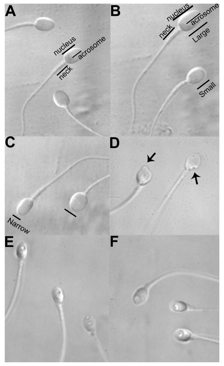 Efficacy of hyaluronic acid binding assay in selecting motile spermatozoa with normal morphology