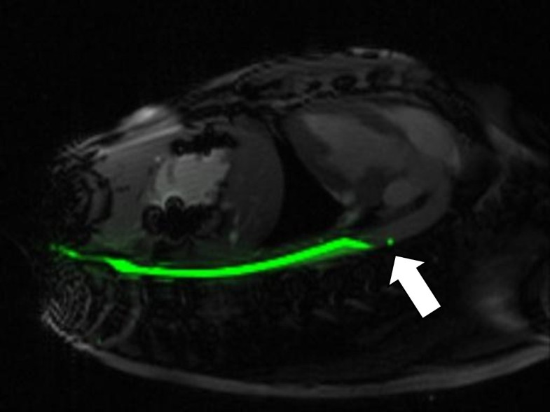 MRI active guidewire with an embedded temperature probe and providing a distinct tip signal to
