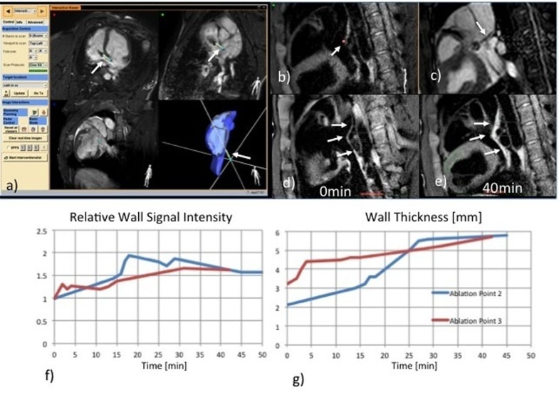 MRguided cardiac radiofrequency ablation with cathetertracked local