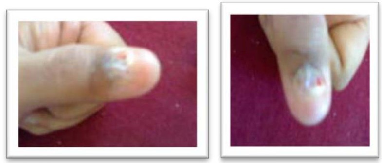 hiv transmission through finger cuts hiv transmission through finger cuts
