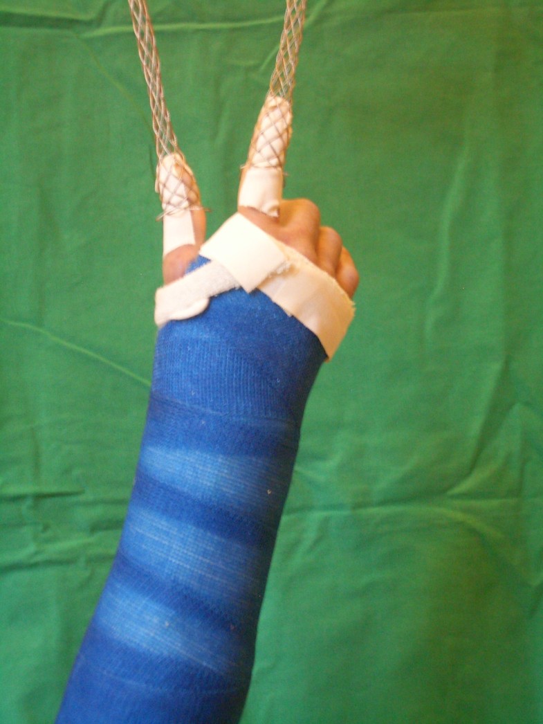 Open Reduction And Internal Fixation Versus Casting For Highly