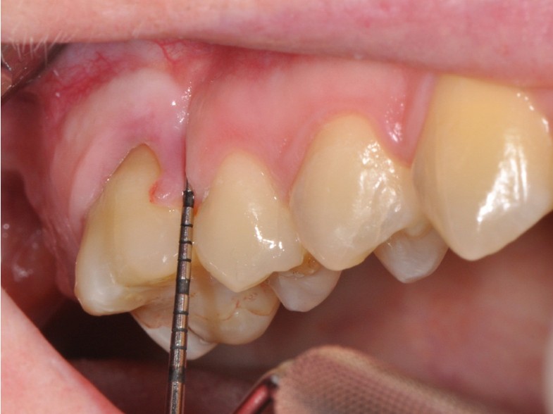 Influence of time after extraction on the development of gingival