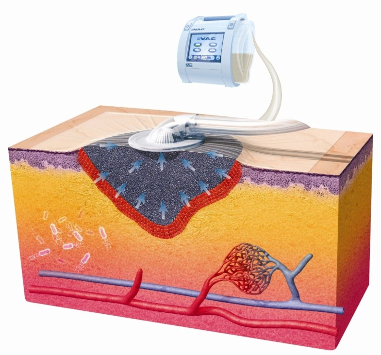 Treatment of subcutaneous abdominal wound healing impairment after