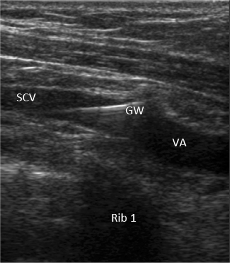 Guidance And Examination By Ultrasound Versus Landmark And Radiographic ...