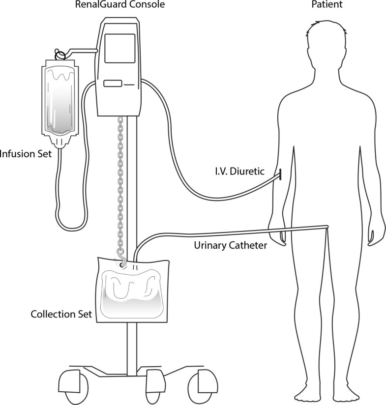 Forced diuresis with matched hydration in reducing acute kidney injury