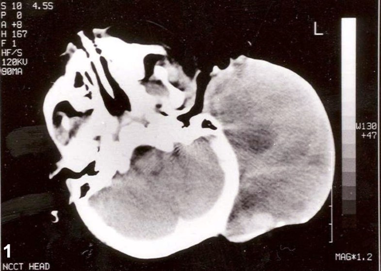 Postauricular congenital alveolar rhabdomyosarcoma- a case report of an