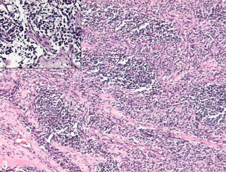 Postauricular congenital alveolar rhabdomyosarcoma- a case report of an