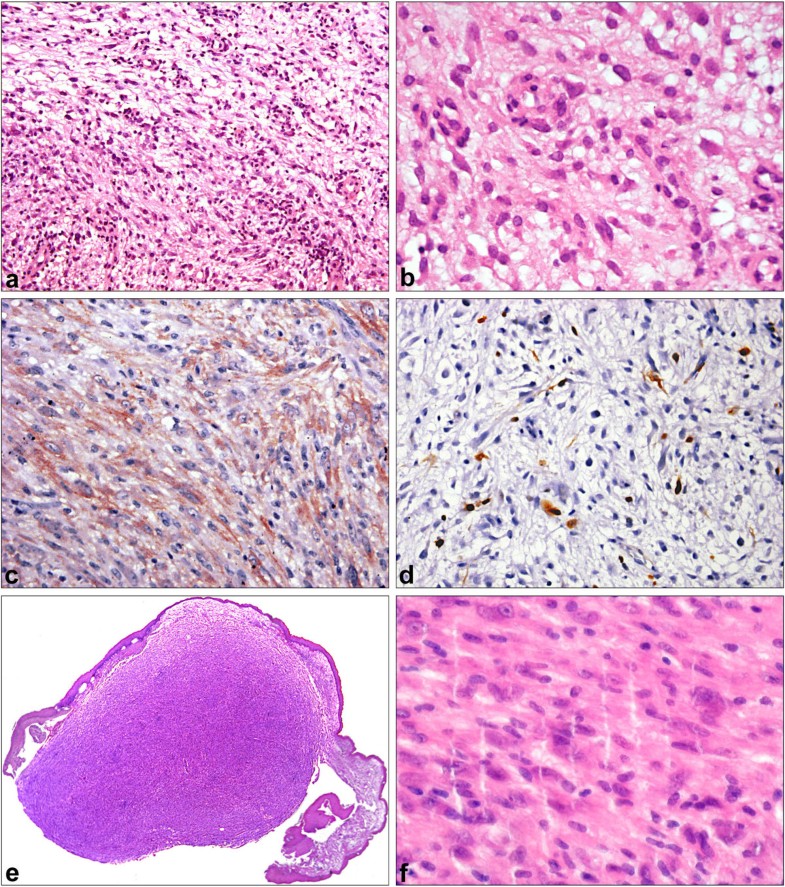 spindle cell tumor spindle cell tumor