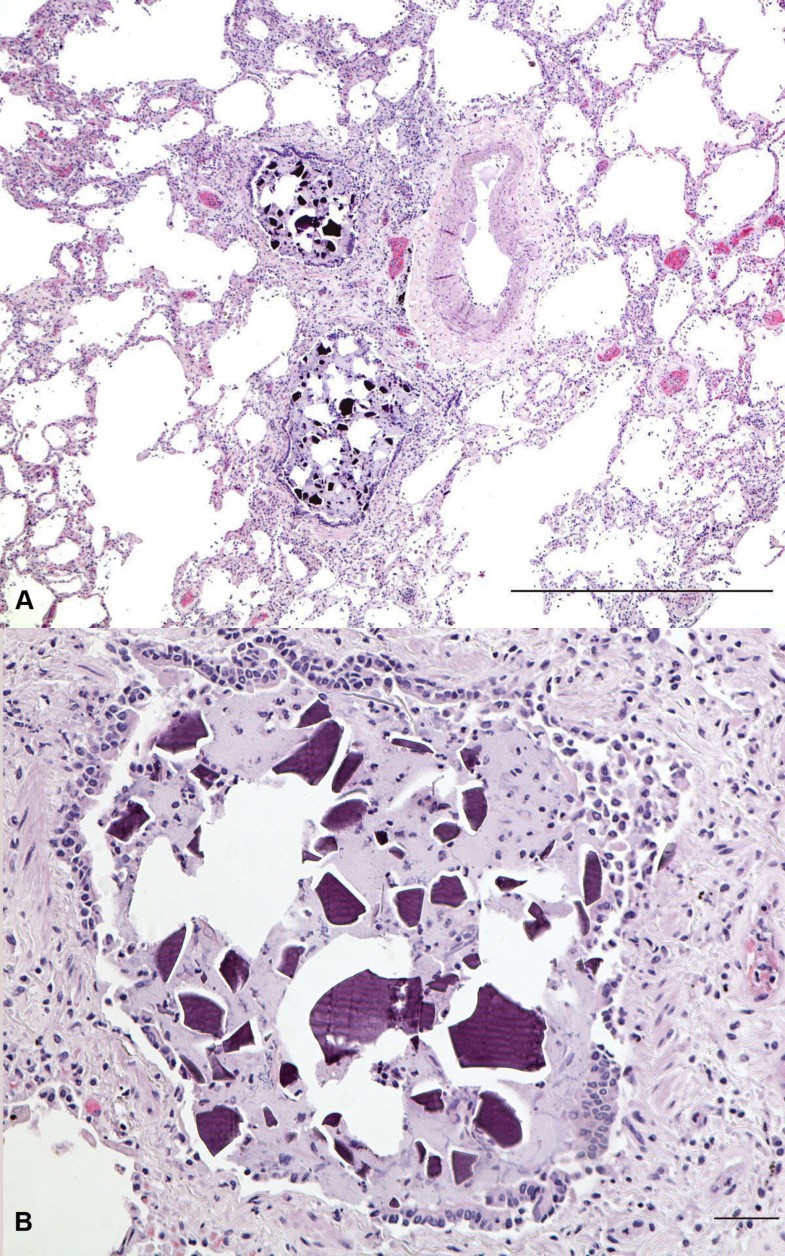 sodium-polystyrene-sulfonate-kayexalate-aspiration-diagnostic-pathology-full-text