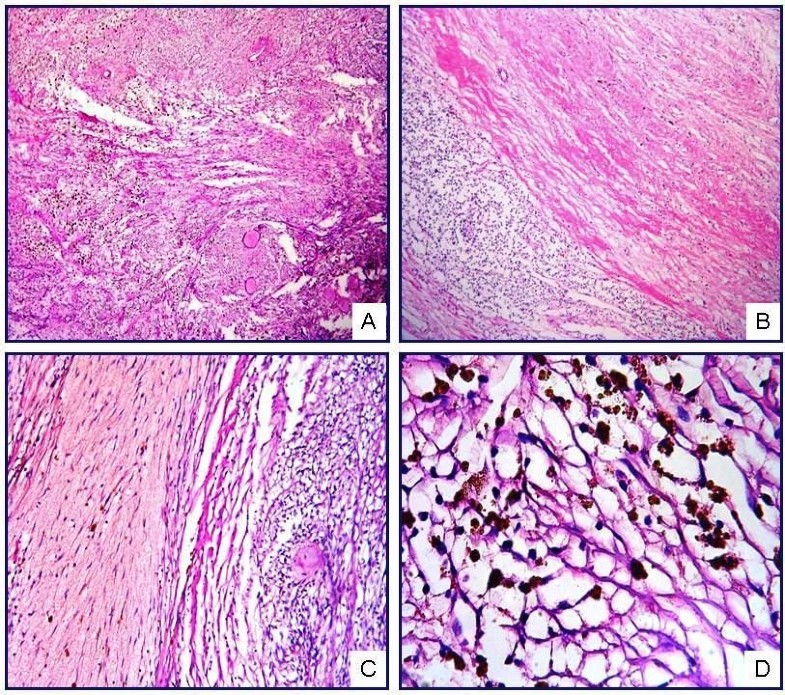 Intranodal palisaded myofibroblastoma (intranodal hemorrhagic spindle ...