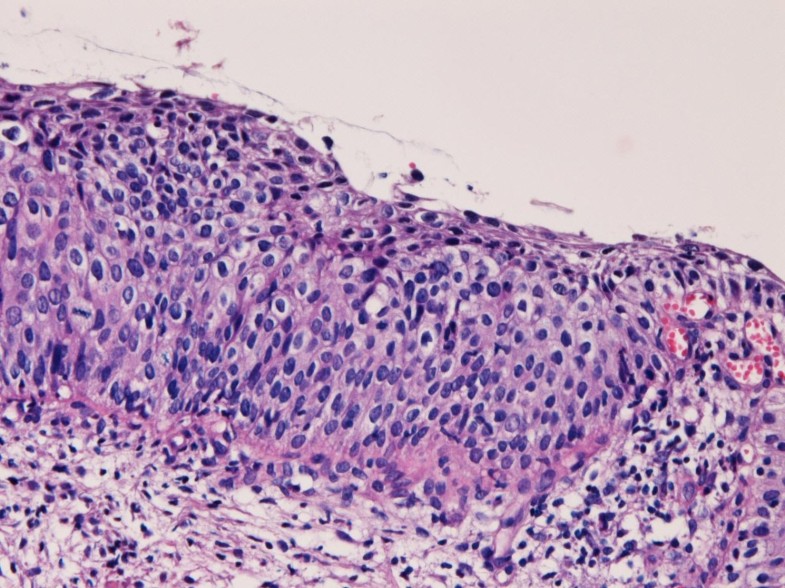 Coexistence Of Early Microinvasive Endometrioid Adenocarcinoma And Cin3 In The Uterine Cervix In 