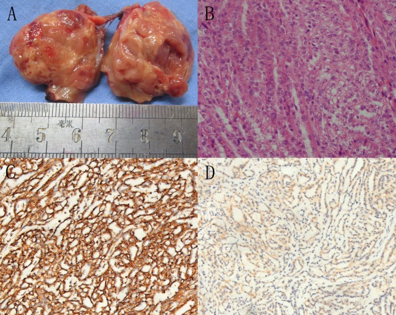 Renal mucinous tubular and spindle cell carcinoma a report of 8 cases