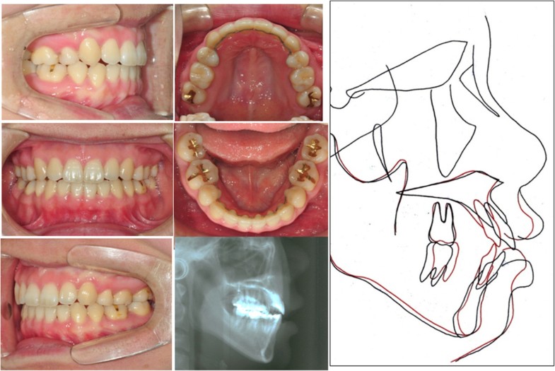 Anteroposterior lingual sliding retraction system for orthodontic