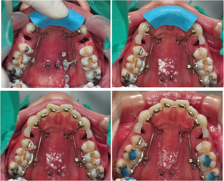 Anteroposterior lingual sliding retraction system for orthodontic