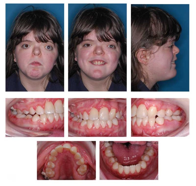 The spectrum of Apert syndrome phenotype, particularities in