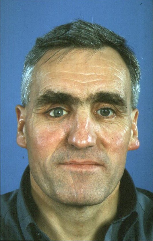 facial injury from angle grinder use management and