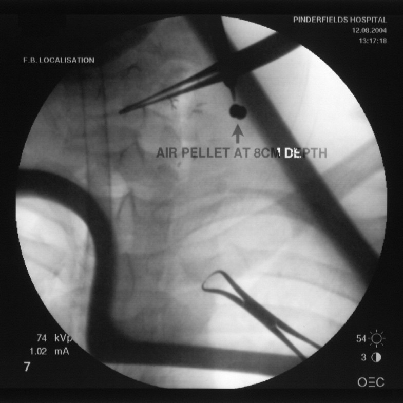 Carotid artery injury from an airgun pellet a case report and review