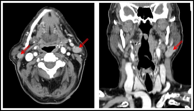 Bilateral Multifocal Warthins Tumors In Upper Neck Lymph Nodes Report