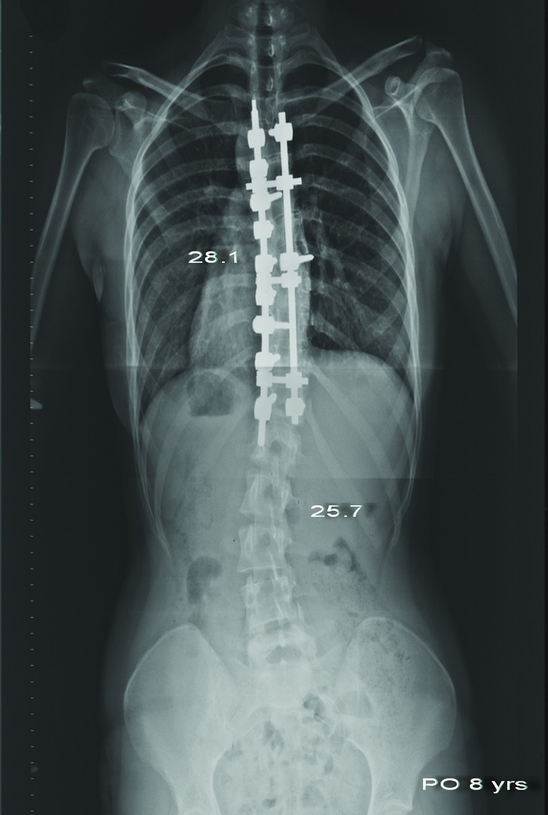 Juvenile Idiopathic Scoliosis Treated With Posterior Arthrodesis And ...