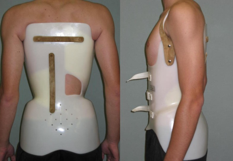 Brace technology thematic series The Sforzesco and Sibilla braces, and the SPoRT (Symmetric