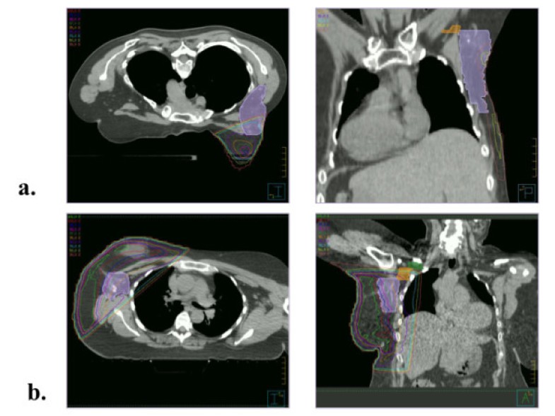 Axillary lymph node dose with tangential whole breast radiation in the