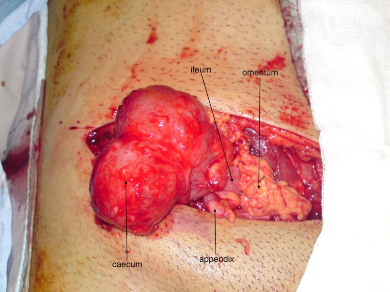 Acute Direct Inguinal Hernia Resulting From Blunt Abdominal Trauma