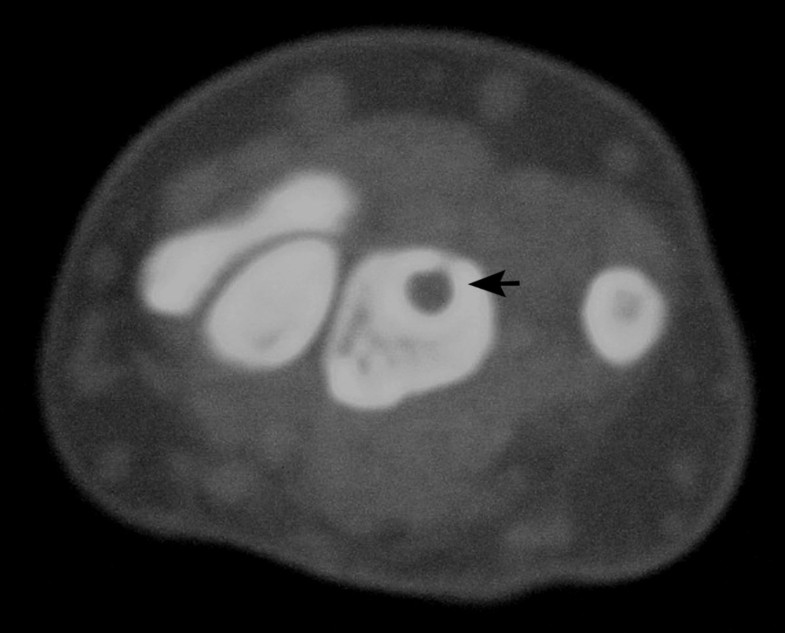 Unicameral bone cyst of the lunate in an adult: case report | Journal